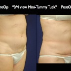 TummyTuck.040