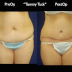 TummyTuck.042