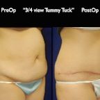 TummyTuck.043