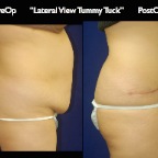 TummyTuck.044