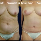 TummyTuck.045