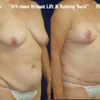 TummyTuck.046