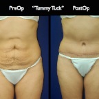 TummyTuck.048