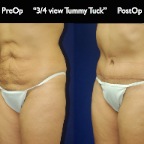 TummyTuck.049