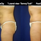 TummyTuck.050