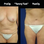 TummyTuck.051