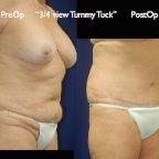 TummyTuck.052