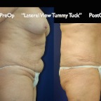 TummyTuck.053