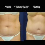 TummyTuck.054