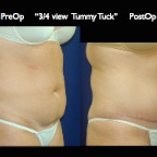 TummyTuck.055