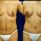 TummyTuck.057