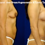 TummyTuck.059