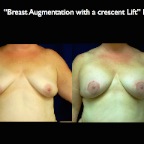 Breast-Aug.004