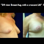 Breast-Aug.005