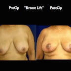 BreastLift.001