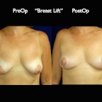 BreastLift.004