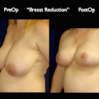 Breast Reduction.002