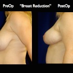 Breast Reduction.003