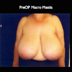 Breast Reduction.004