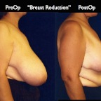 Breast Reduction.006