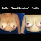 Breast Reduction.007