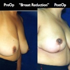 Breast Reduction.008