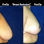 Breast Reduction.009