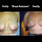 Breast Reduction.010