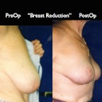 Breast Reduction.011