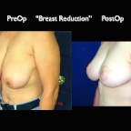 Breast Reduction.013