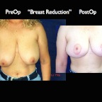 Breast Reduction.014