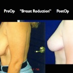 Breast Reduction.015