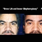 BrowLift2.003