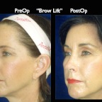 BrowLift2.004