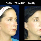 BrowLift2.005