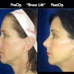 BrowLift2.006