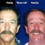 BrowLift2.008