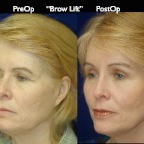 BrowLift2.012