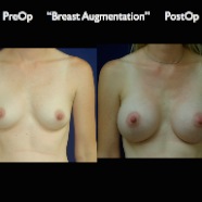 Breast-Aug.043