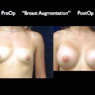 Breast-Aug2.001