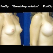 Breast-Aug2.002