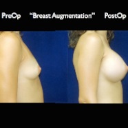 Breast-Aug2.003