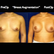 Breast-Aug2.004