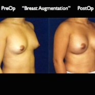 Breast-Aug2.005