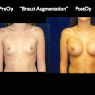 Breast-Aug2.007