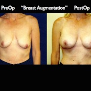 Breast-Aug2.011