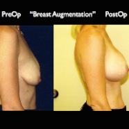 Breast-Aug2.012