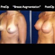 Breast-Aug2.013