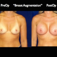 Breast-Aug2.014