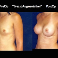 Breast-Aug2.016